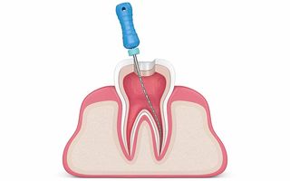 Dental root canal Wagga Illustration